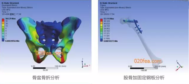 有限元分析法在結構、醫(yī)學、流體與熱及電場的分析與應用